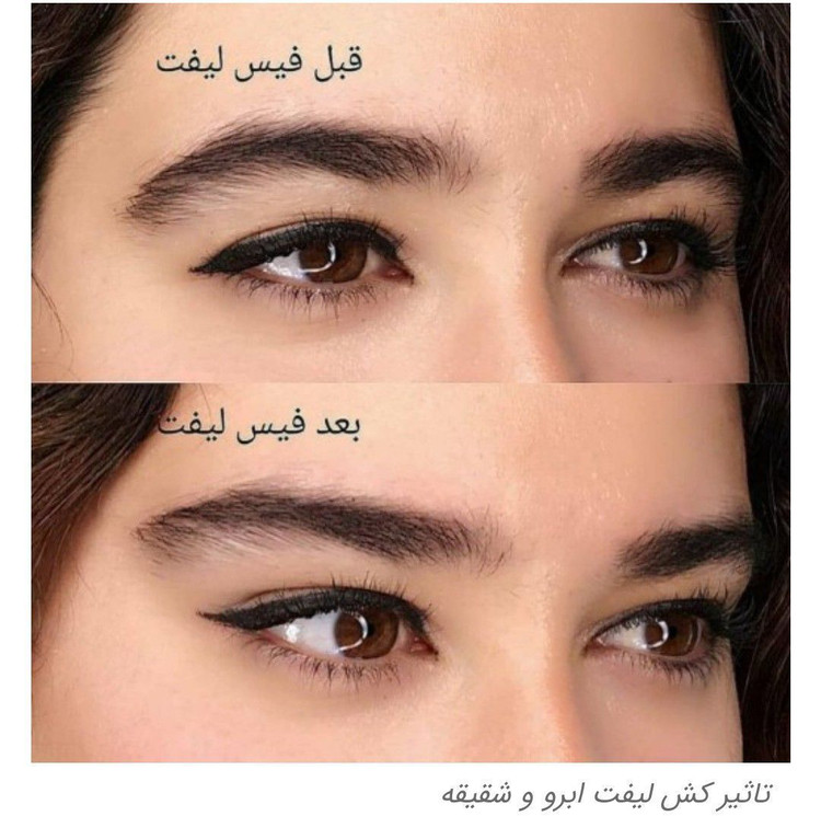 کش لیفت ابرو وشقیقه